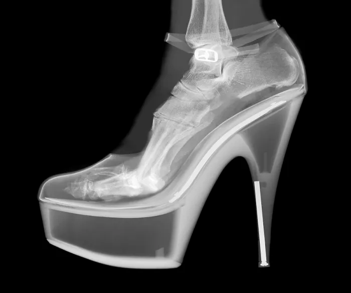 Framed Print : An X-ray of a foot in a High Heel Shoe
