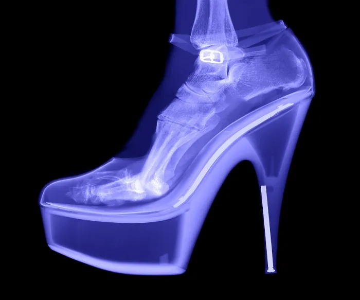 Framed Print : An X-ray of a foot in a High Heel Shoe Framed Print : An X-ray of a foot in a High Heel Shoe