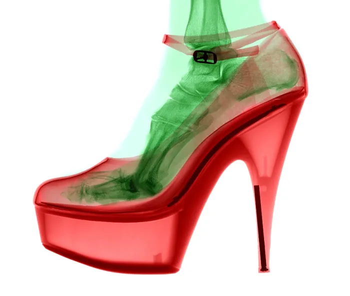 Framed Print : An X-ray of a foot in a High Heel Shoe