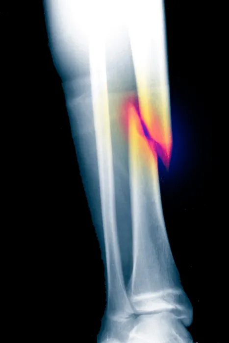 Framed Print : X-ray of fractured tibia
