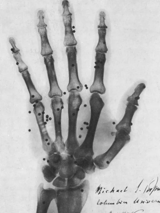 Framed Print : X-ray of Gunshot in the Hand, 1896 Framed Print : X-ray of Gunshot in the Hand, 1896