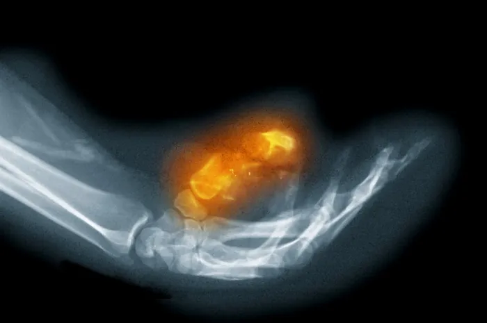 Framed Print : X-Ray of a Gunshot Wound to the Hand Framed Print : X-Ray of a Gunshot Wound to the Hand