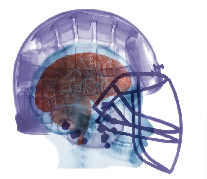 Framed Print : X-ray of Head in Football Helmet Framed Print : X-ray of Head in Football Helmet
