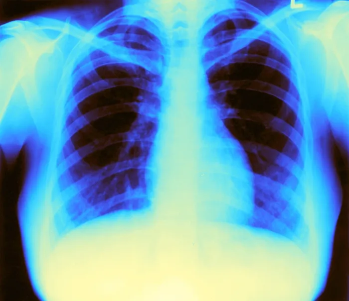 Framed Print : X-ray of Heart and Lungs Framed Print : X-ray of Heart and Lungs