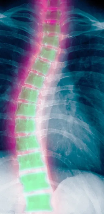 Framed Print : X-ray of scholiosis Framed Print : X-ray of scholiosis