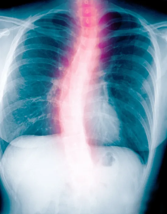 Framed Print : X-ray of scholiosis Framed Print : X-ray of scholiosis