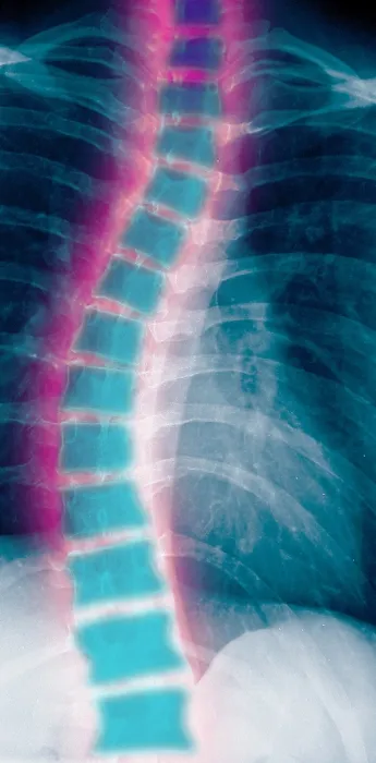 Framed Print : X-ray of scoliosis Framed Print : X-ray of scoliosis