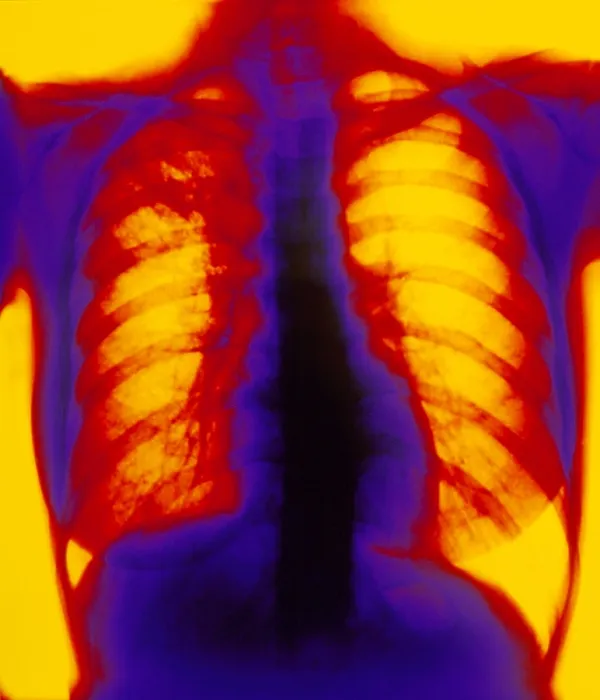 Framed Print : X-ray showing pulmonary tuberculosis Framed Print : X-ray showing pulmonary tuberculosis