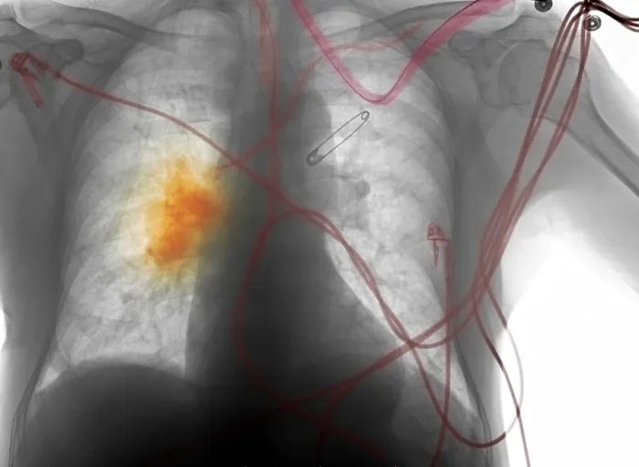 Framed Print : X-ray, Smoker's Chest Framed Print : X-ray, Smoker's Chest