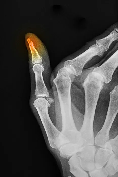 Framed Print : X-ray of Thumb Fracture