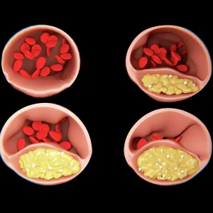 Atherosclerosis, artwork