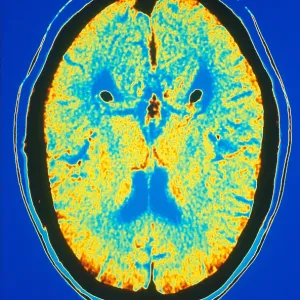 Brain, CT Scan