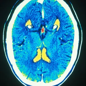 Brain, CT Scan