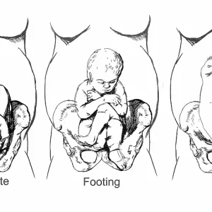 Breech Birth Positions, Illustration