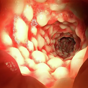 Crohn's disease, artwork