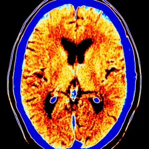 CT scan of section through healthy brain