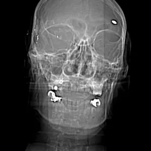 CT Scout View, Bullet Fragments