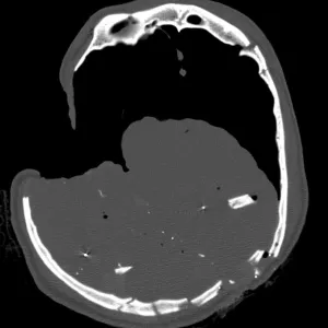 CT Section, Gunshot Wound