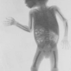 Infant X-Ray, 1900
