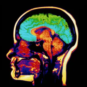 MRI brain scan