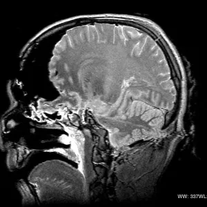 MRI Cross Section, Wound Track