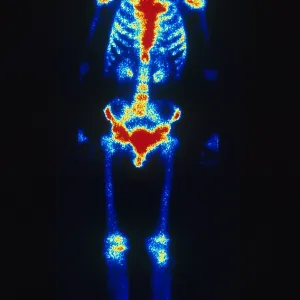 Normal Bone Scan