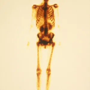Normal Bone Scan