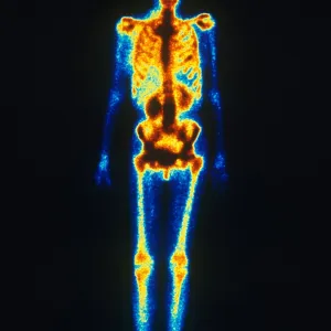 Normal Bone Scan