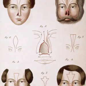 Nose Reconstruction, 1815 Medical Text