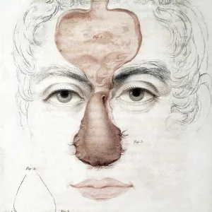 Nose Reconstruction, 1815 Medical Text