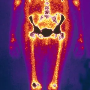 Osteomyelitis