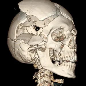 Three-Dimensional CT Reconstruction, Skull with Bullet Wounds