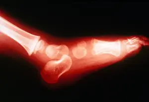 Test Prints: 2 Year Old's Foot, X-ray