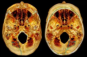 Scan Prints: 3D CT Reconstruction of Skull Fracture