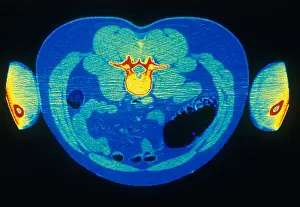 Project Prints: Abdomen, CT Scan