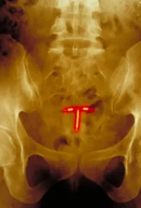 Device Prints: Abdomen x-ray
