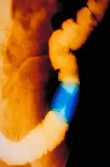 Research Prints: Abdomen X-Ray of colon cancer
