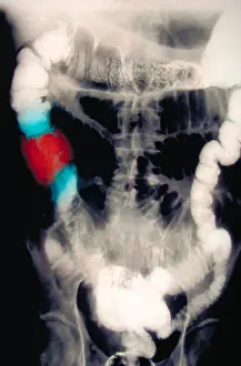 Research Prints: Abdomen X-Ray of colon cancer