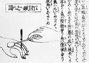 Chart Prints: Acupuncture, Moxa Treatment, 1718