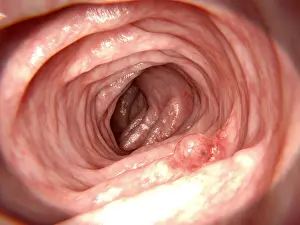 Pathological Prints: Adenomatous polyp