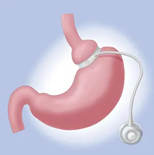 Device Prints: Adjustable Gastric Band