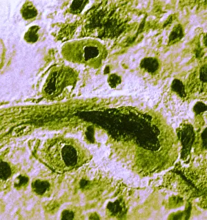 Lung Prints: Advanced Lung Cancer