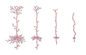 Diagram Prints: Alzheimer's Disease, Neuron Degeneration
