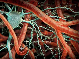 Neurological Prints: Amyloid Plaque