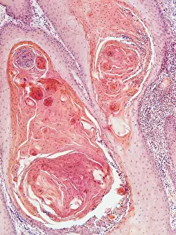 : Anal Squamous Cell Carcinoma, a common type of anal cancer, light micrograph