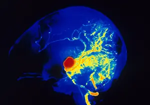 Circulation Prints: Aneurysm