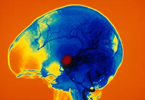 Abnormal Prints: Aneurysm
