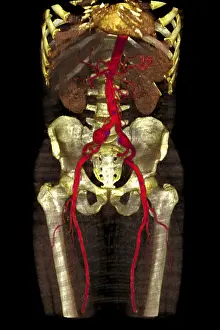 Scan Prints: Aneurysm