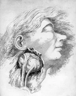 Internal Prints: Aneurysm of the Carotid Artery