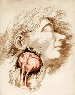 Internal Prints: Aneurysm of the Carotid Artery